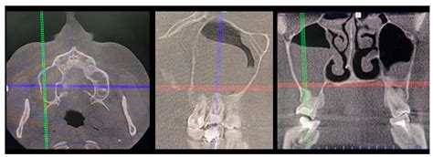 Anatomical and Surgical Implications of the Usage of Bichat Fat Pad in.